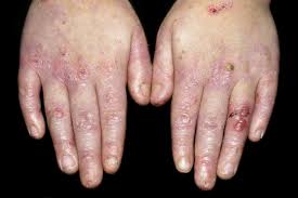 epidermolisis bullosa