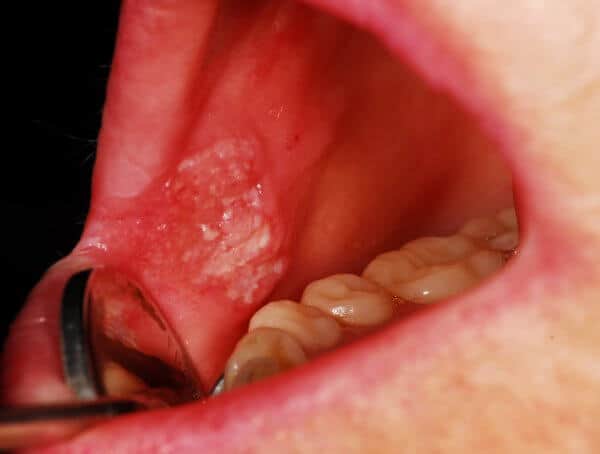 Kanser Mulut (Oral cancer) - Tahap, Simptom, Punca ...