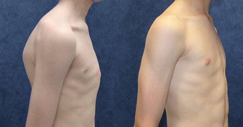 pectus carinatum