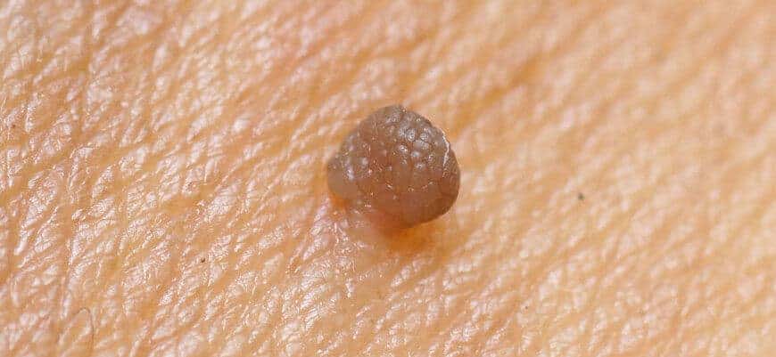 keratosis seborheik