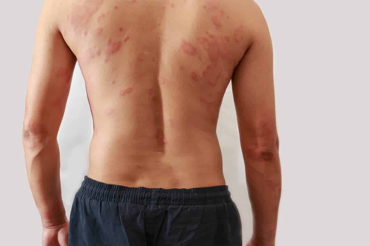 Pityriasis Rosea