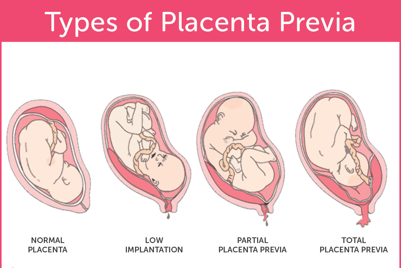 Placenta Previa