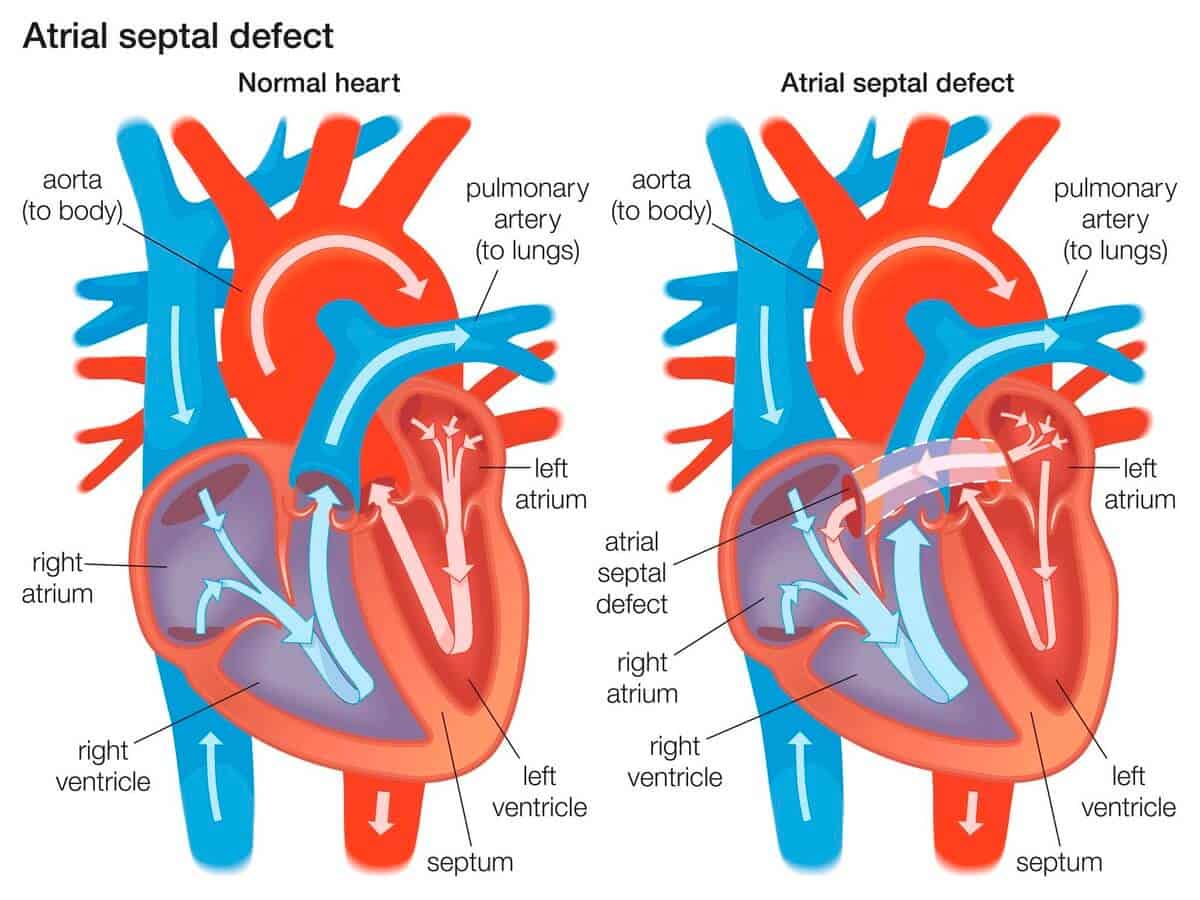 kecacatan septum atria