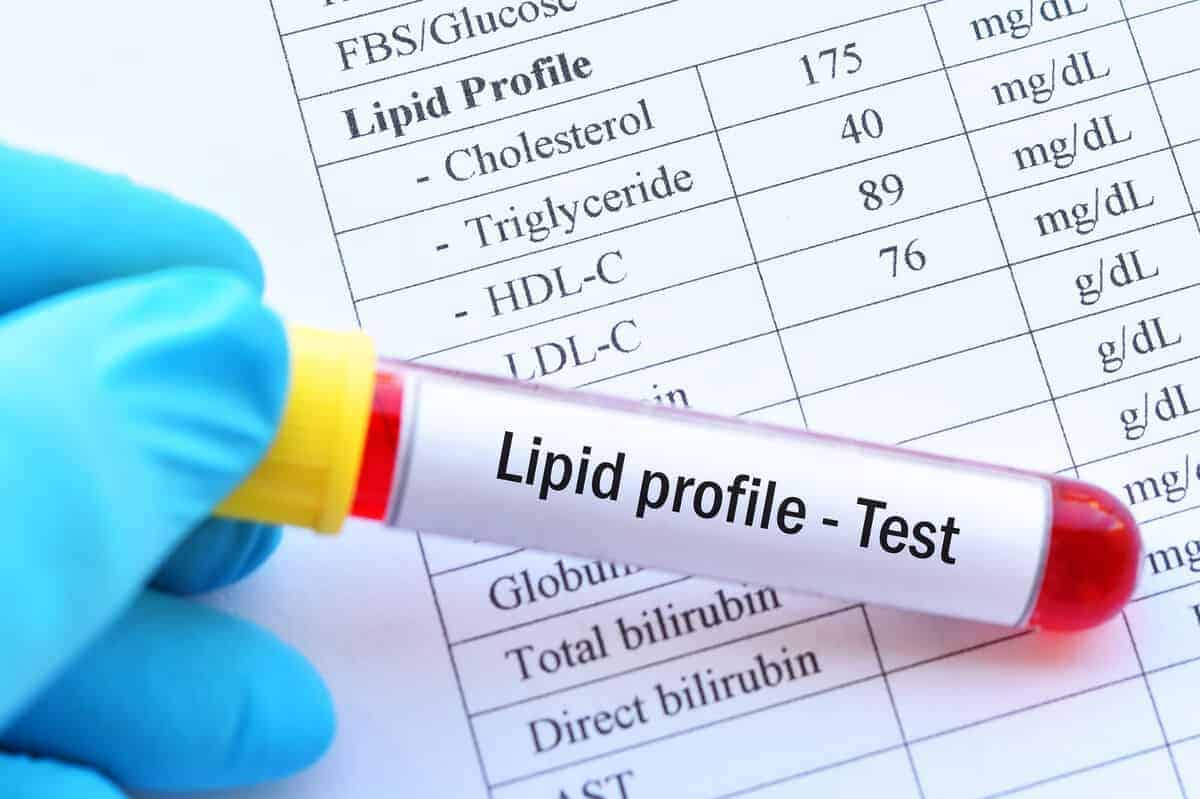 Ujian profail lipid