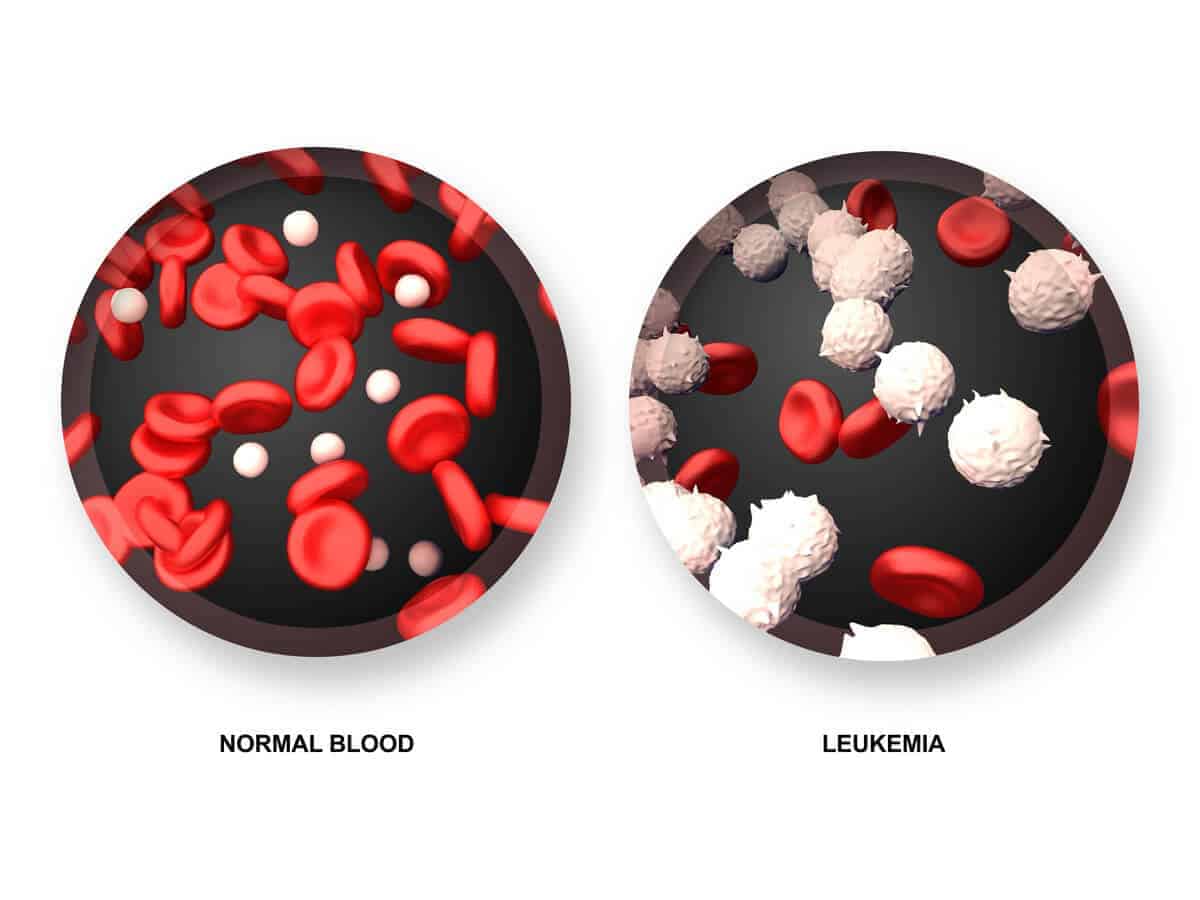 leukemia