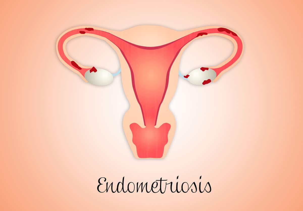 Endometriosis