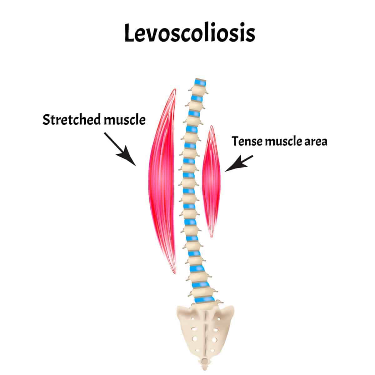 Levoscoliosis