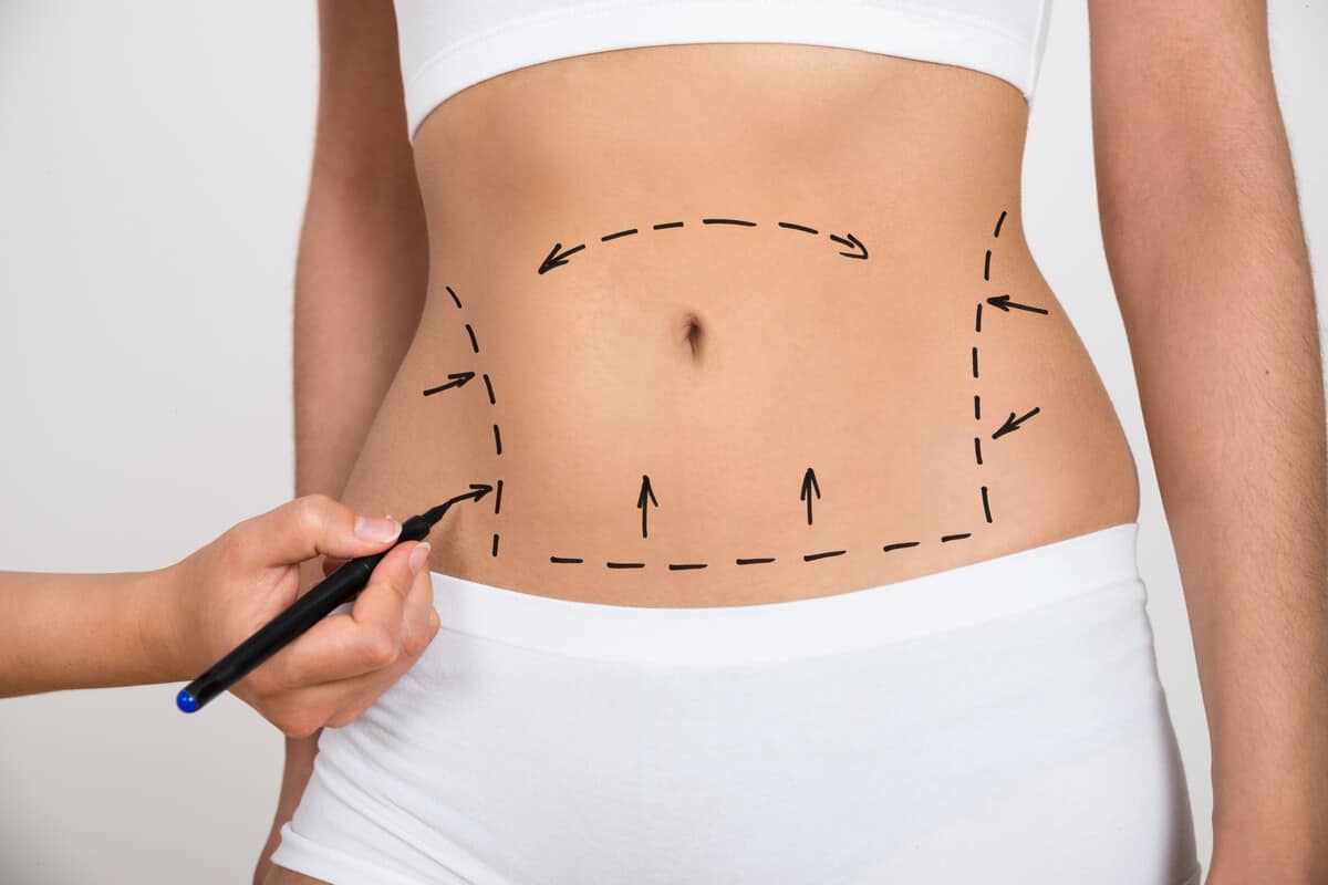 liposuction