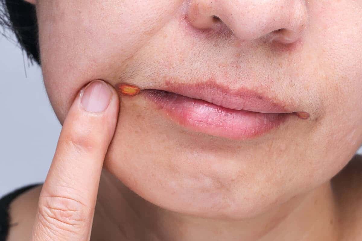 Angular cheilitis