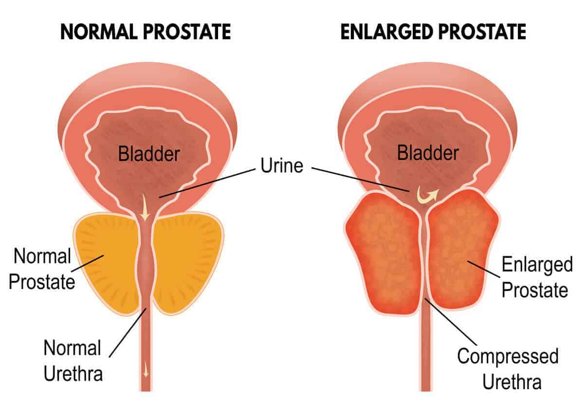 Hiperplasia prostat