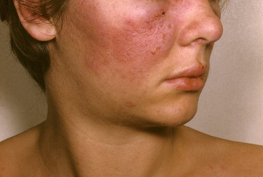 systemic lupus erythematosus