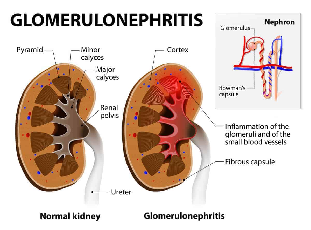 Glomerulonephritis