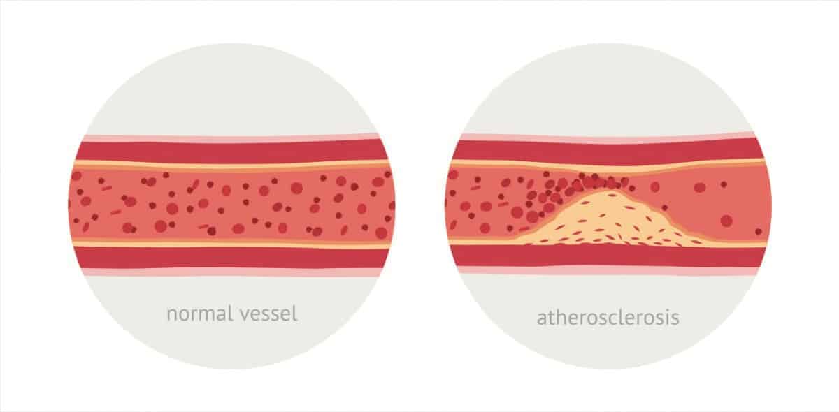 Arteriosklerosis